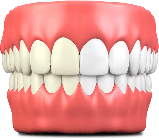 teeth whitening graphic