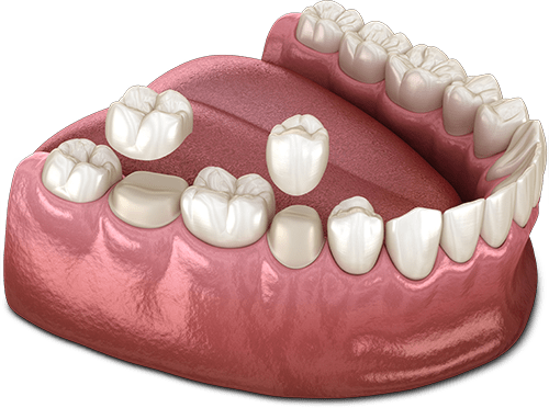 dental crown model