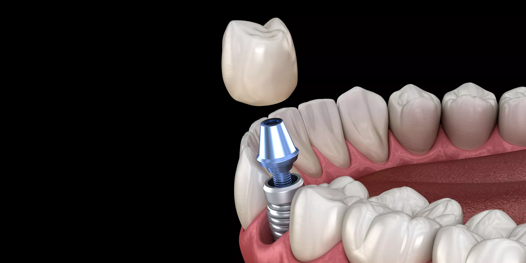 Методика зубного имплантирования