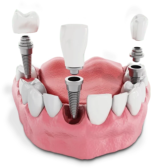 Graphic With Multiple Dental Implants