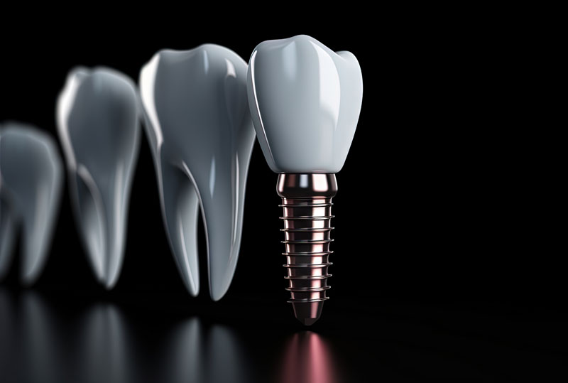 Digital model of a dental implant on a blacked-out background