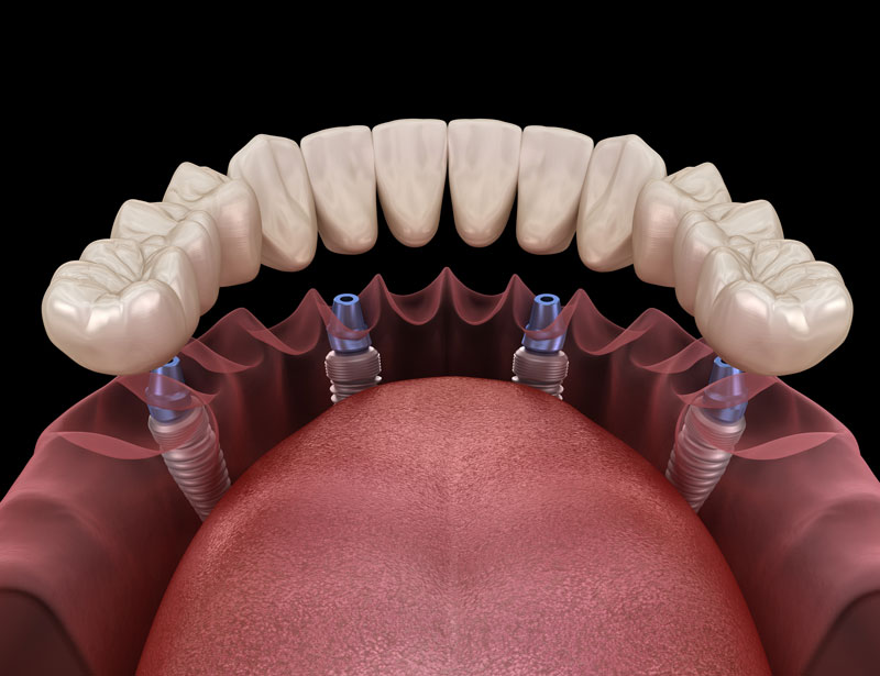 full mouth dental implants, lower jaw model 3d rendered
