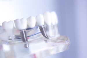 Dentist and patient discussing dental implant procedure in a modern clinic